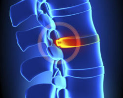 chiropractic courses on Disc bulge and herniation