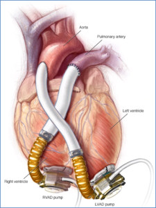 A Biventricular Assist Device BIVAD