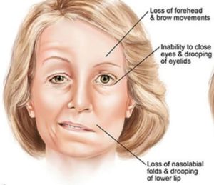 Bell's Palsy 