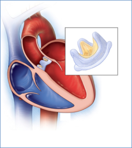 Biological Valve Replacement
