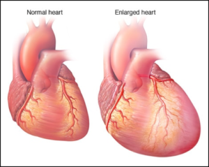 Enlarged Heart Versus a Normal Heart in Cardiomyopathy