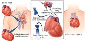 Heart Transplant Procedure