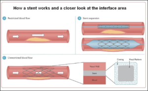 How a Stent Works