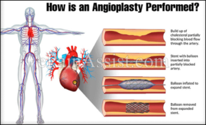 How is Angioplasty Performed
