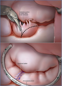Repair of the Mitral Heart Valve