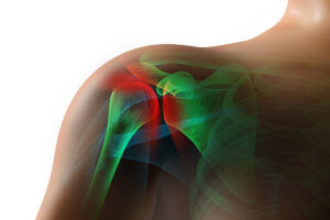 High resolution 3D rendering of an injured shoulder in pain.  Composite image of x-ray includes clipping plane for background change.