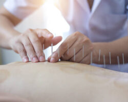 Traditional Chinese Medicine Treatment - Acupuncture